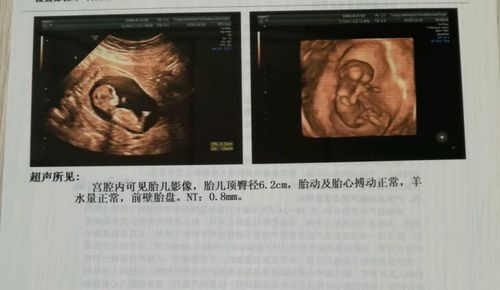 12周 5天 nt顺利通过