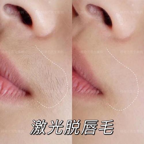 【杨奇元医生-激光脱唇毛案例】