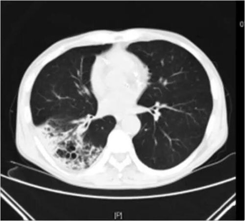 「典型」肺炎链球菌大叶性肺炎不典型