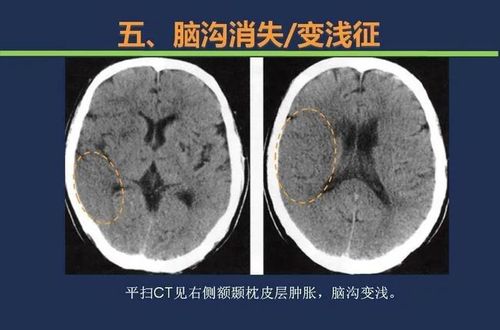 头颅ct如何预判超早期脑梗死