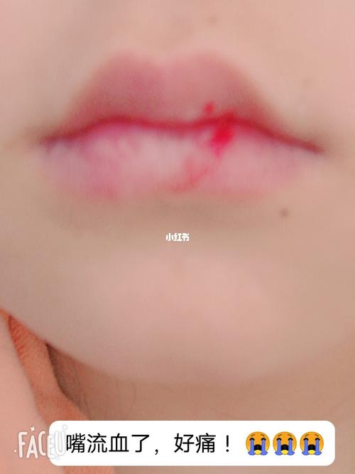 嘴巴真的流血了,好痛_整形_美妆_医美_美妆_医美整形