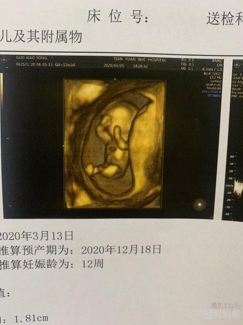 nt顺利通过了,看到显示屏上的宝宝蹬蹬腿