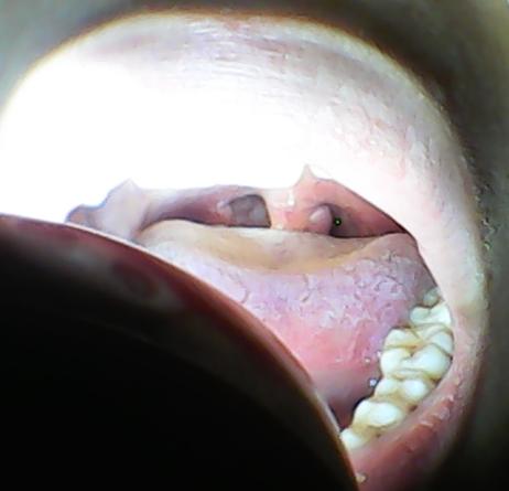 喉咙小舌头有一个球不疼不痒不影响吃东西