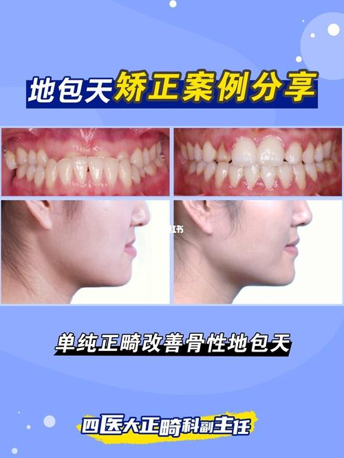 矫正案例/正畸改善骨性地包天案例_正畸_口腔_牙齿矫正_美妆_医美整形