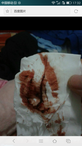 用了妇科宝,剖腹产的,子宫里面的垃圾全排出来了