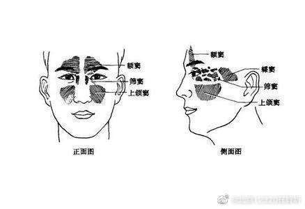 什么是上颌窦炎