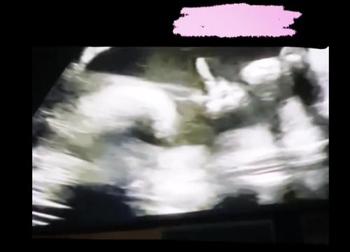 水果姐晒b超视频 腹中胎儿宝宝似乎在跟妈妈"打招呼"