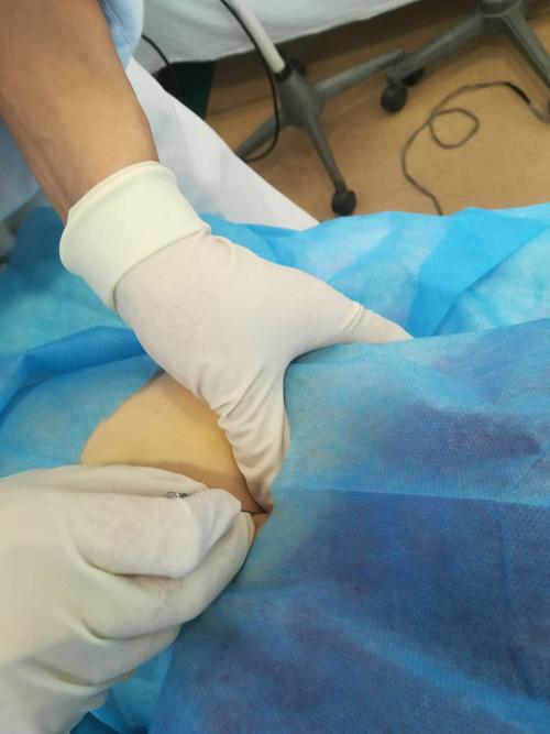 髋关节注射定位穿刺中,一步到位.