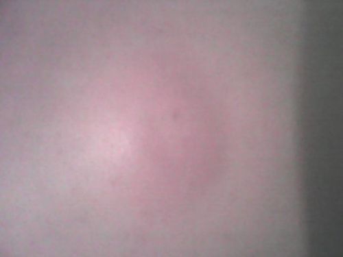 紧急这是什么东西啊后背上起个包挺大