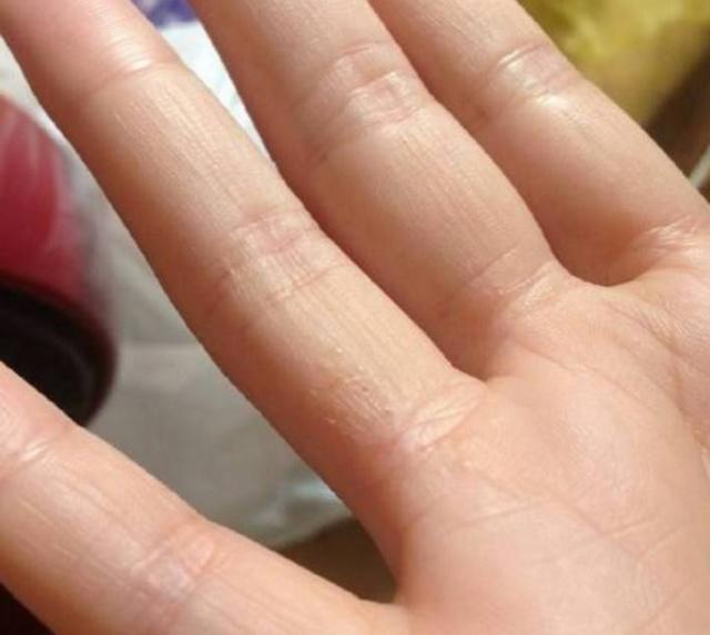 一定要注意,手上出现这种小水泡,你身体在向你求救,抓紧查下!