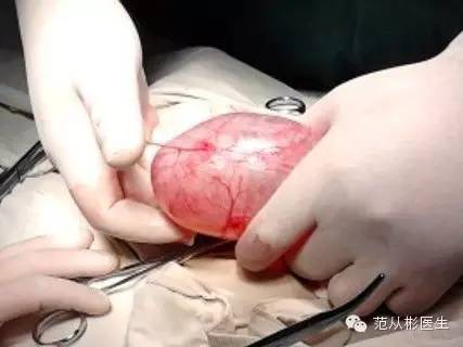 "蛋蛋"突然增大警惕睾丸癌