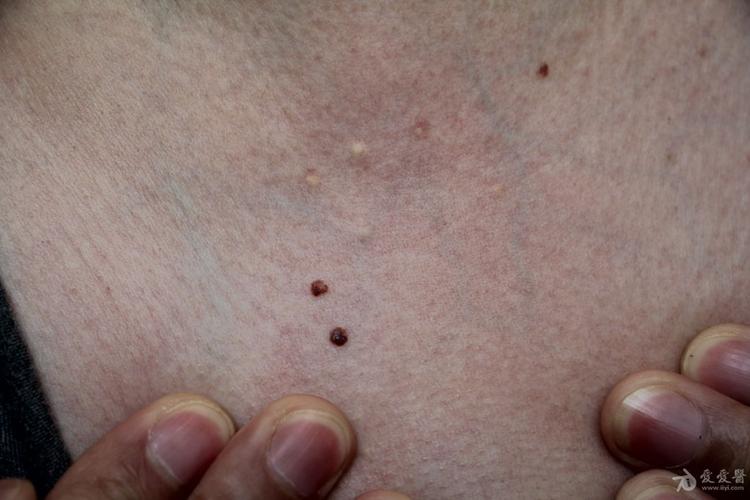 常见病--皮肤脂囊瘤.