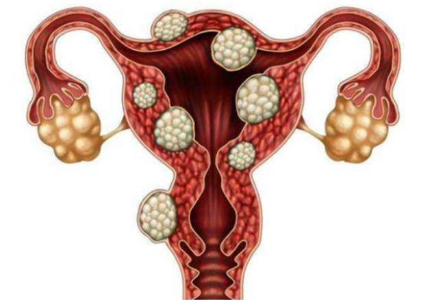 如果得了子宫肌瘤会引起疼痛,阴道出血,便秘,反复流产,尿急尿频等.