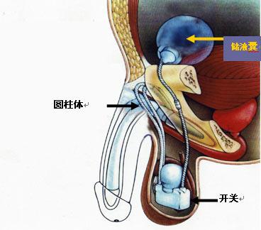 阴茎假体人工海绵体植入简介