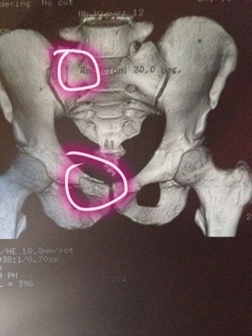 2013-12-07 陶威宇 医师 8月1号去医院复查了,左侧坐骨及耻骨骨质形态