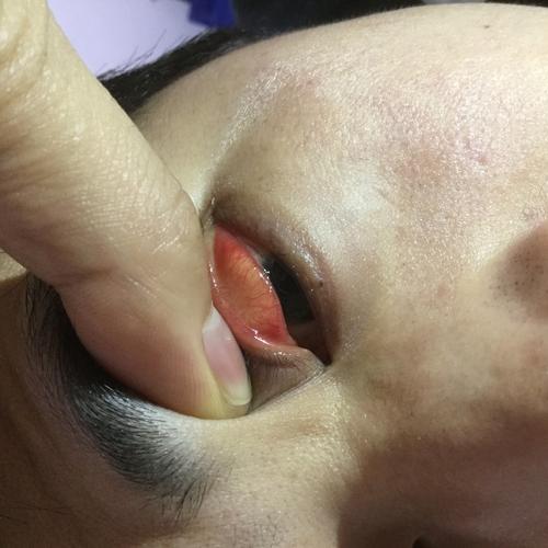 是沙眼还是结膜炎总感觉眼睛不适求鉴定