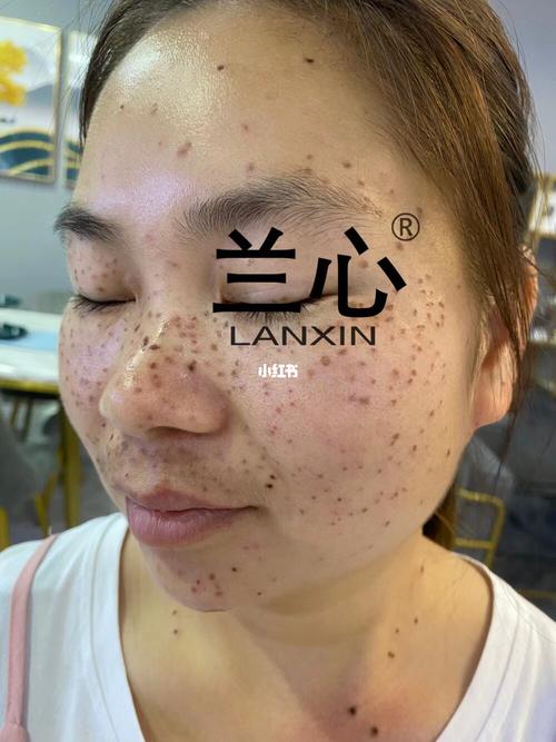 有人说祛斑结痂不好看_祛斑_药水点斑_美妆_护肤