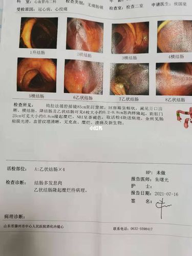 肠镜出结果了请大家帮我看看 求求了_结肠癌_医疗健康