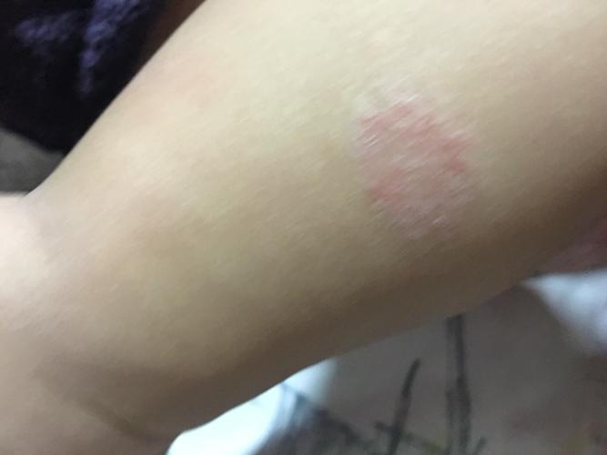 宝宝小腿上长圆藓