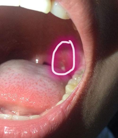 我喉咙痛咽东西都疼还咳嗽怎么办