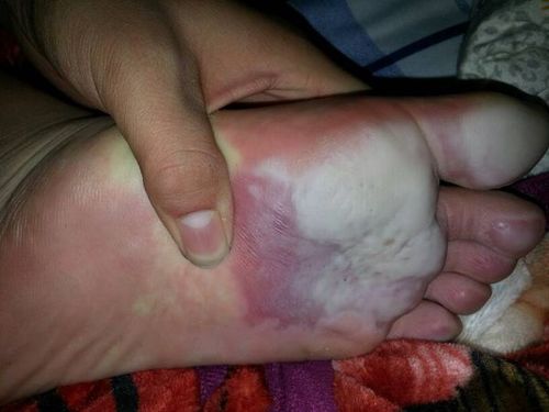 我的脚底板很痛,每次洗完脚以后都是这个样