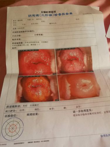 最近发现内裤上有酸味,去医院检查医生说我宫颈糜烂三度要做手术我19