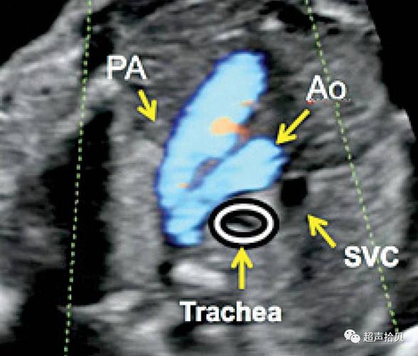 让我们一起再复习一下三血管气管切面在胎儿心脏疾病诊断的价值(1)