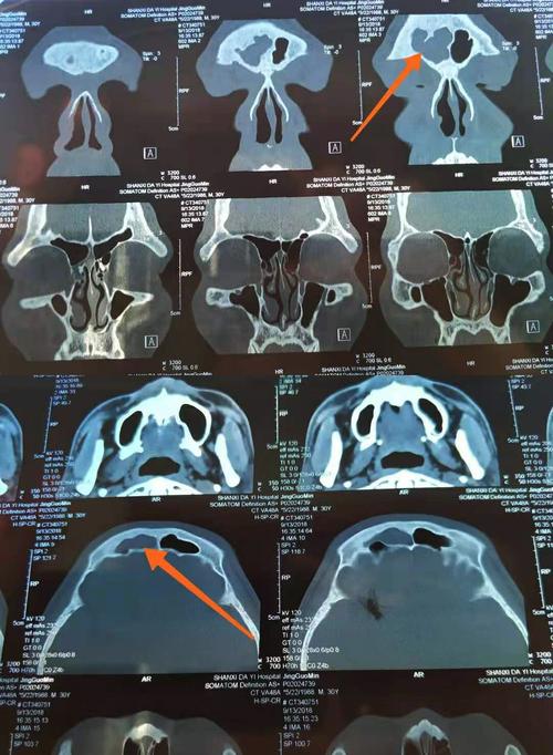邹女士患额窦炎多方治疗无效果,听申力医生建议手术后终于治愈