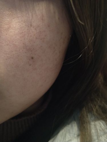 像痘印一样一块块的但不是痘印怎么办