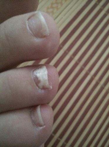 脚趾甲变白是怎么回事