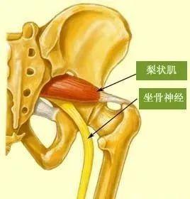 梨状肌综合症处理