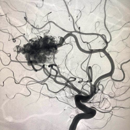 刘思鼎,男,32,脑动静脉畸形(右侧大脑前动脉一远端分支血管供血)脑室