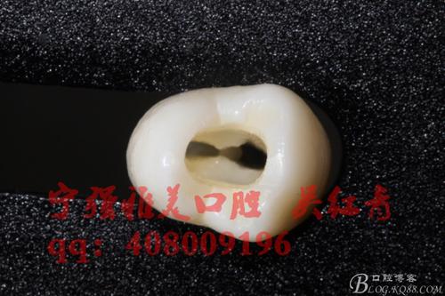 几种方式根管治疗的肤浅对比之一