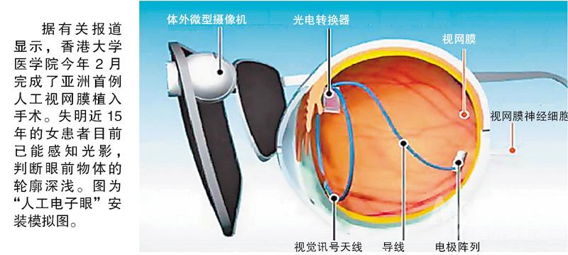冰城专家解析『人工电子眼』 将为被挖眼男童安装