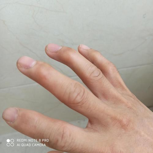 先天性这样,手指关节略微粗大,伸不直,不是肿的!