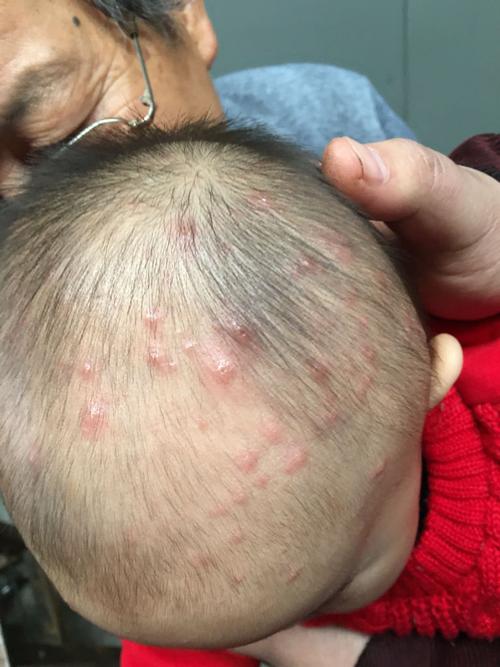 请问一下,我家宝宝这个是水痘还是病毒性皮疹?