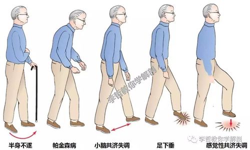 步态系列(5)---年龄与步态模式,正确步态的反义词一定是不正确的步态