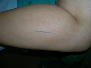 骨癌患者早期会在骨的表面出现一个硬的肿块,有痛或不痛的症状. 2.