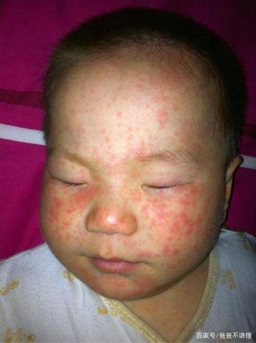 "出疹子"之所以急,是因为"急疹"的出现很突然,几乎没有先兆.