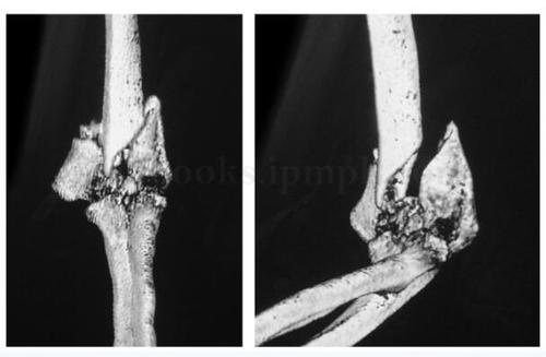 图2‐1‐31 术前肘关节ct 片