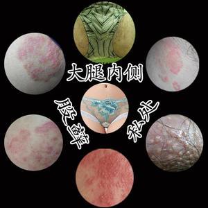 阴囊潮湿瘙痒去潮湿男士特效干爽成人私处止痒外用膏肛门肛周