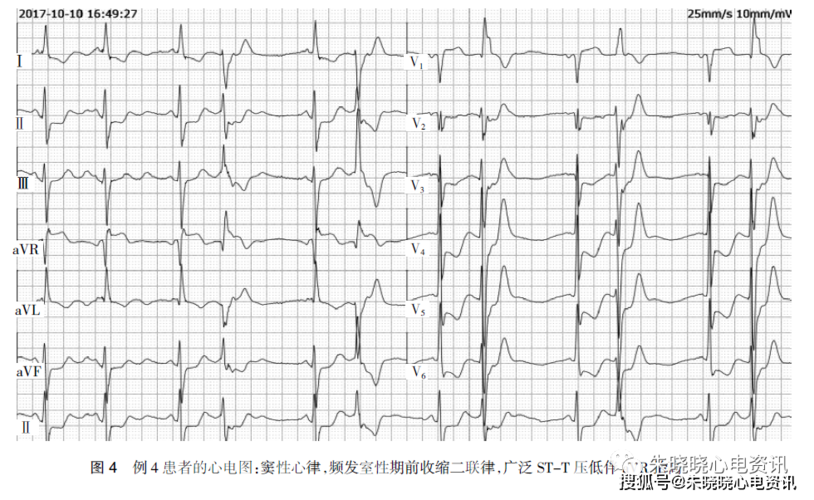 st段改变表现的猝死预警心电图