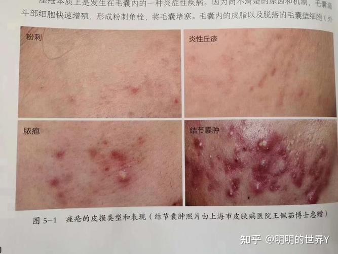 痤疮痘肌脸最权威用药高治愈攻略篇