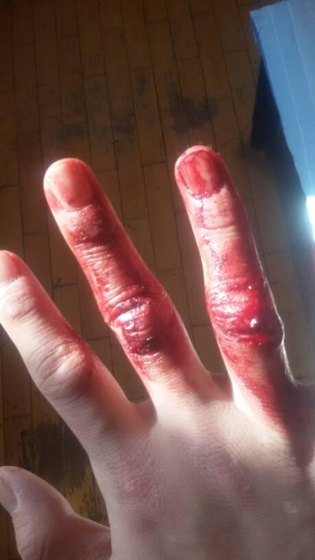 一时冲动用手把玻璃炸碎了,现在伤口上的血凝固了,有一个小时没处理了