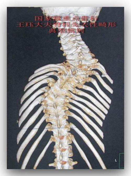 一例严重先天性脊柱畸形