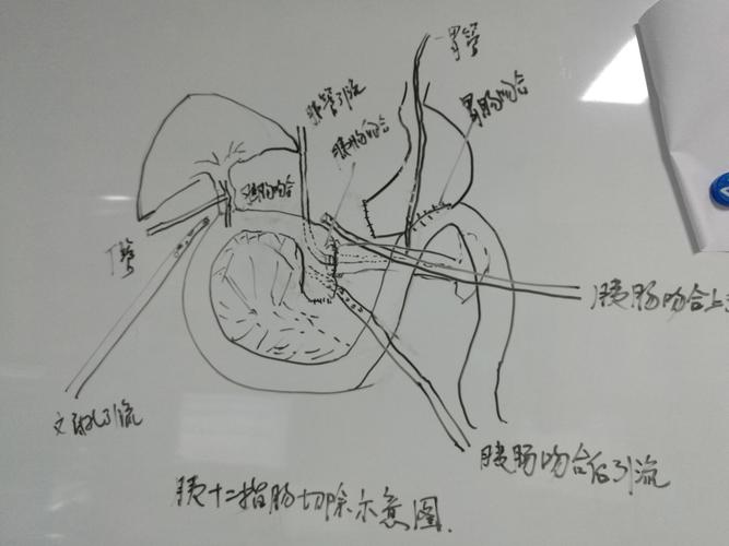"胰管空肠粘膜对粘膜 陈氏c形包埋胰肠吻合"在胰十二指肠切除术中的