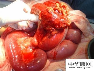 肠梗阻对患者的危害