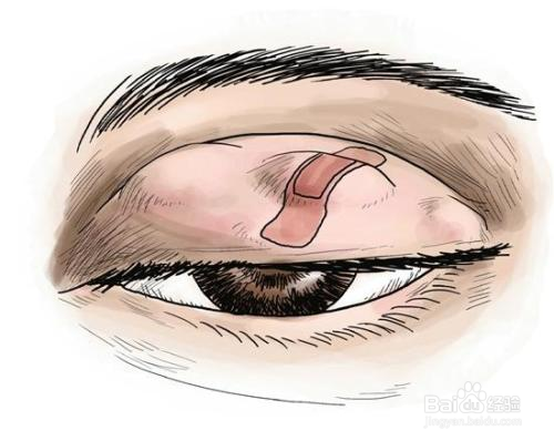 眼睛总是发痒,还有刺痛感,是怎么回事儿?