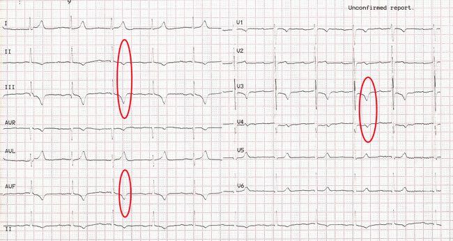 心电图t波改变是怎么回事儿就是冠心病吗