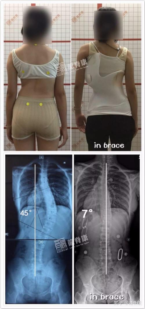 青少年脊柱侧弯患者脱支具的条件有哪些